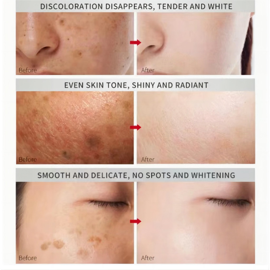 FreeShipping Philippines BUY 2 TAKE 3 Japanese Melasma Cream Yunnan Herbal Whitening Freckle Cream Original Whitening remover cream for face effective anti-aging FreeShipping Philippines BUY 2 TAKE 3 Japanese Melasma Cream Yunnan Herbal Whitening Freckle Cream Original Whitening remover cream for face effective anti-aging